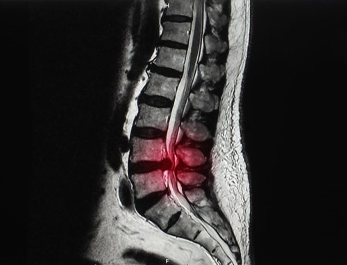 What is spinal stenosis and how is it treated?